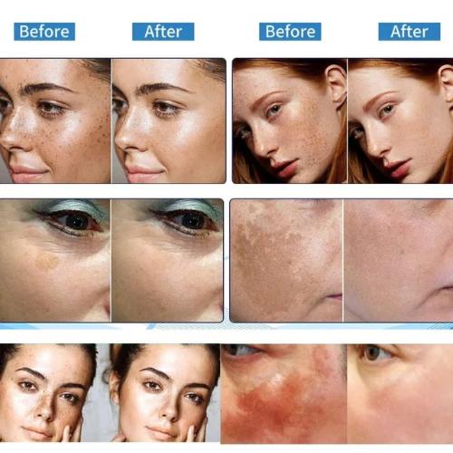 Vitamin C Whitening Freckles Face Cream Remove Melasma Dark Spots Lighten Melanin